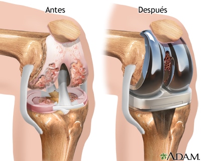Fisioterapia prótesis de rodillas