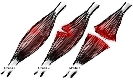 Roturas de fibras musculares y sus grados
