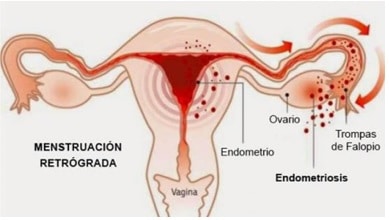 Tratamiento endomitriosis fisioterapia